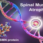 Medical Blog on Spinal Muscular Atrophy